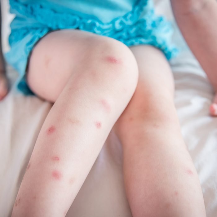 العديد من لدغات البعوض تؤلم وتندب على أرجل الطفل الصغير الذي يجلس على السرير