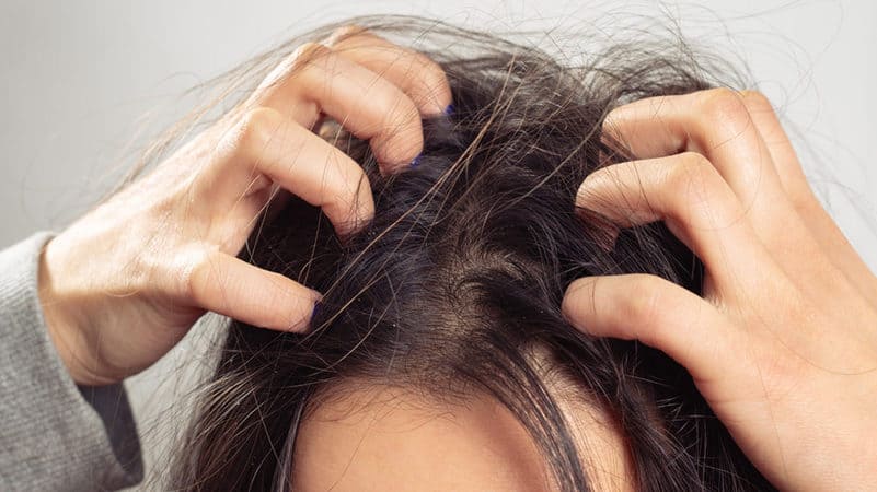 تساقط الشعر الوراثي عند النساء 