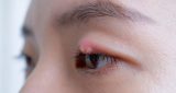 5 علاجات منزلية لعلاج بثور العين بسرعة