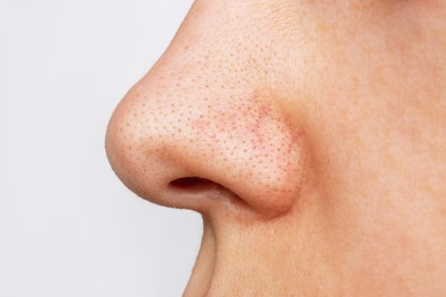 closeup womans nose with blackheads black dots acne problem comedones enlarged pores 407348 11191
