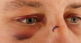 كيفية علاج كدمة العين في 3 خطوات