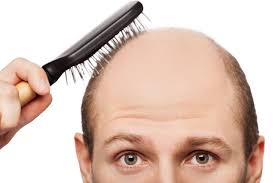 أسباب تساقط الشعر عن الرجال