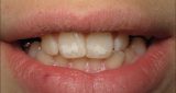 أسباب وعلاج بقع الأسنان البيضاء على الأسنان الأمامية