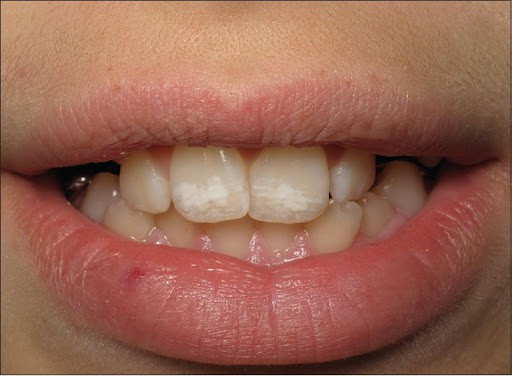 وعلاج بقع الأسنان البيضاء على الأسنان الأمامية أونيلا
